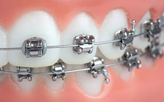 Braces-Types